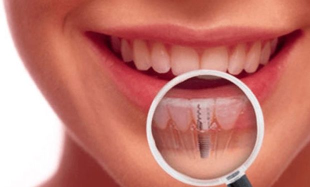 Implant Applications